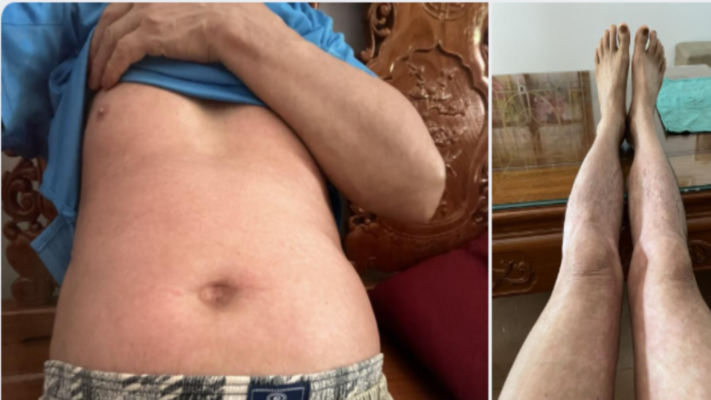 Hình ảnh" một bệnh nhân sau 4 tháng điều trị